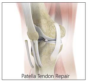 Patellar Tendon Repair Amarillo, TX  Patella Tendon Rupture Treatment  Amarillo